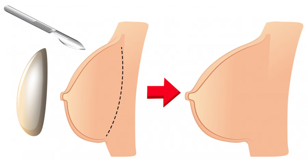 Breast Augmentation Wallace Plastic Surgery Group